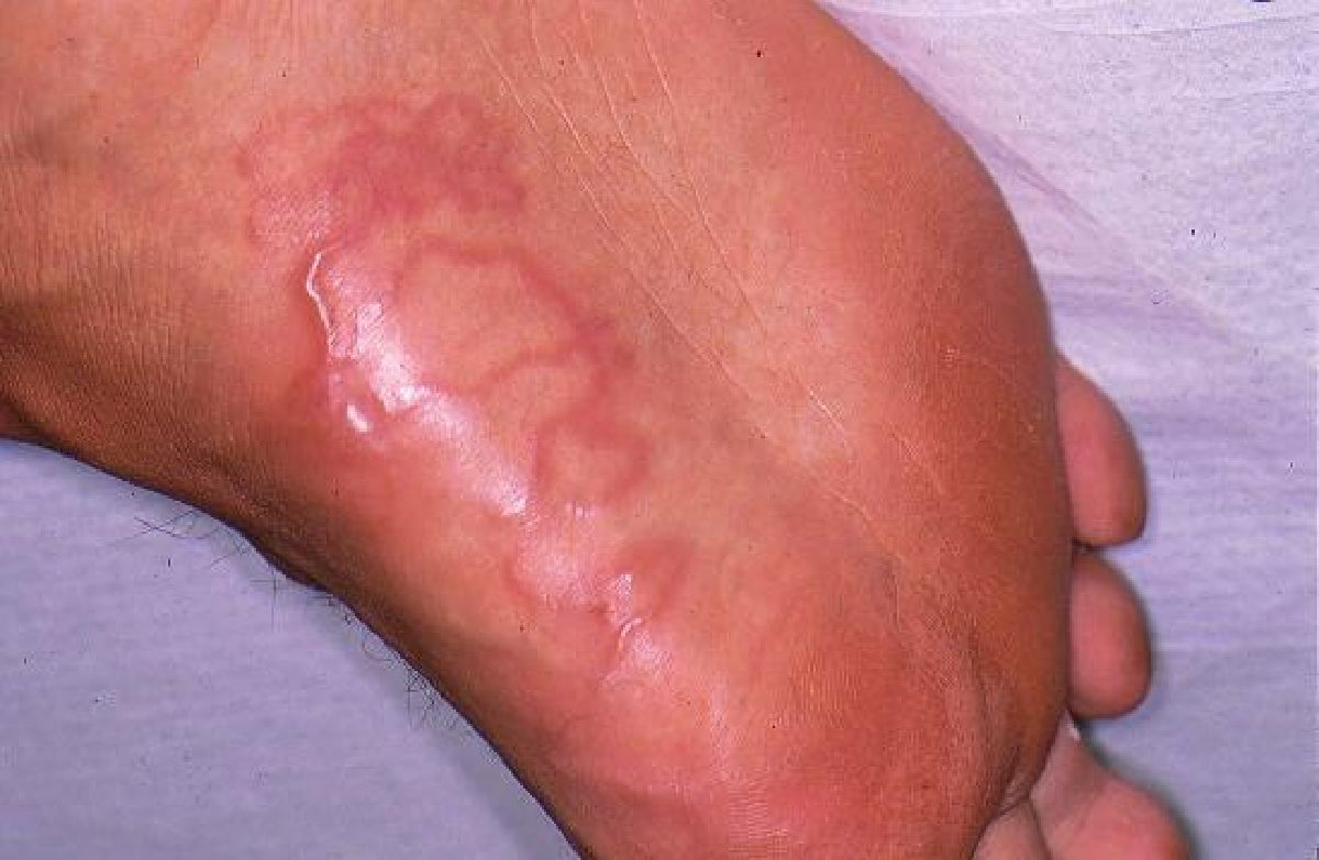 Cutaneous Larva Migran - Mengenal Cutaneous Larva Migrans yang Serang Anak Anji