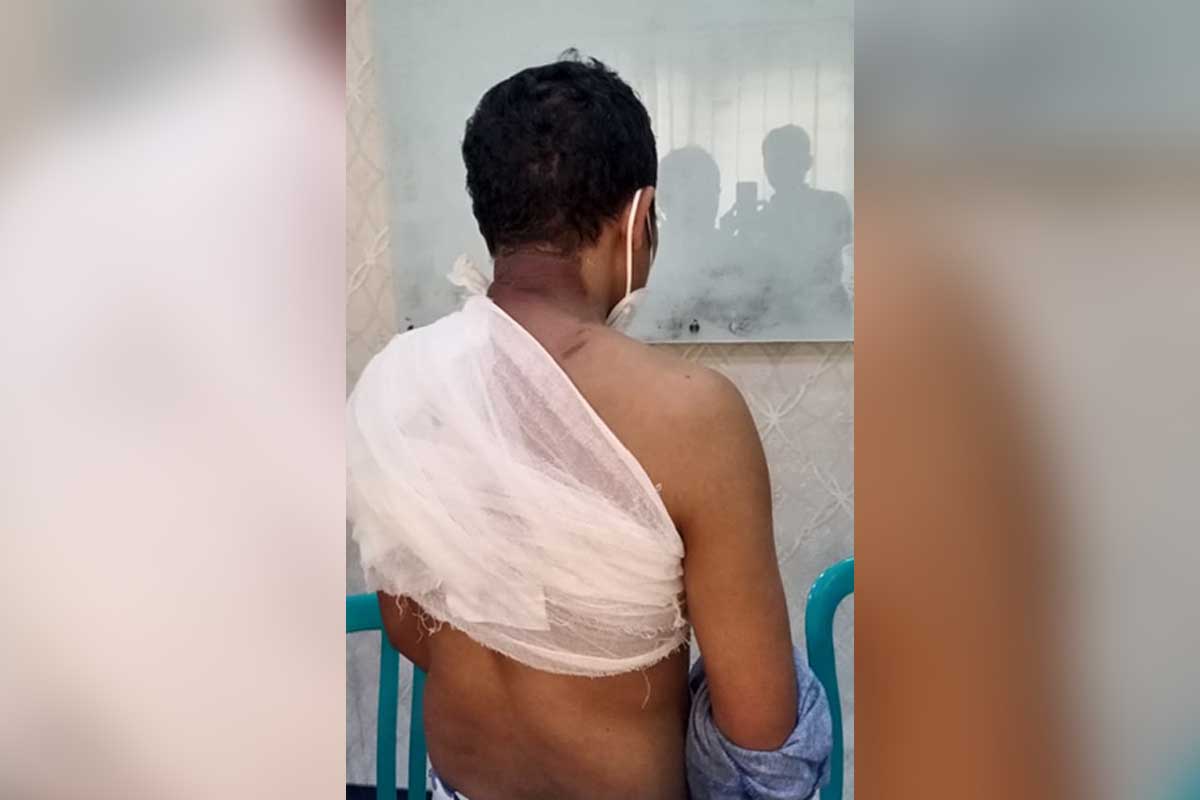 Anggi Tia Warman korban penyiraman air mendidih yang dilakukan oleh tersangka Asbullah. (Ist) - Melerai Adu Mulut, Malah Disiram Air Panas