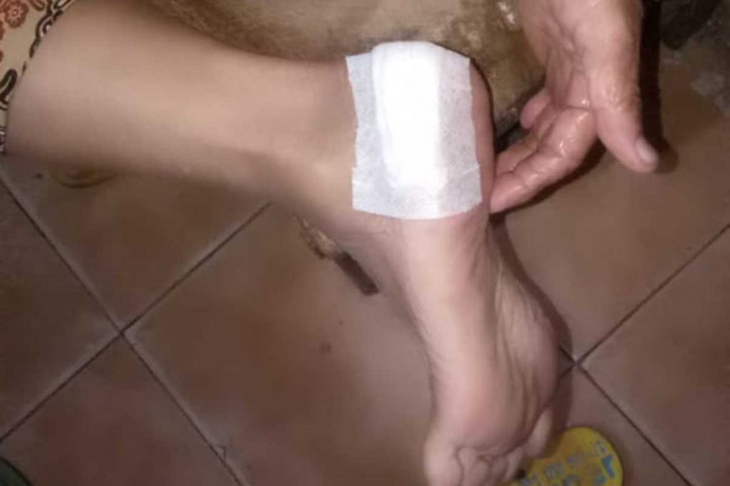 Kaki Muhlawiyah (75) warga Kampung Ujung, Kelurahan Kepatihan, Banyuwangi usai mendapat perawatan akibat gigitan anjing, Senin (28/3/2022) - Kaki Warga Kampung Ujung Jadi Korban Gigitan Anjing Peliharaan