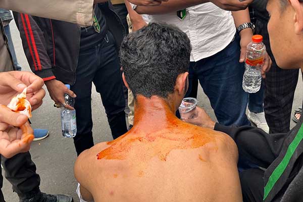 Leher korban/peserta aksi yang terbakar. (bim) - Satu Peserta Aksi Penolakan BBM Di Kota Malang Alami Luka Bakar