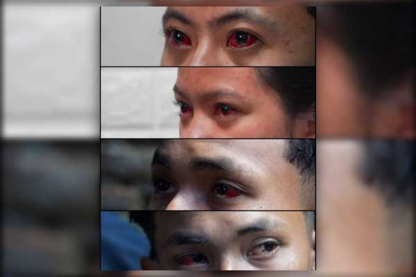 Kondisi mata korban Tragedi Kanjuruhan masih merah, disebabkan gas air mata. (ist) - Kunjungi Korban, TGIPF: Mata Korban Alami Pendarahan Sebab Gas Air Mata