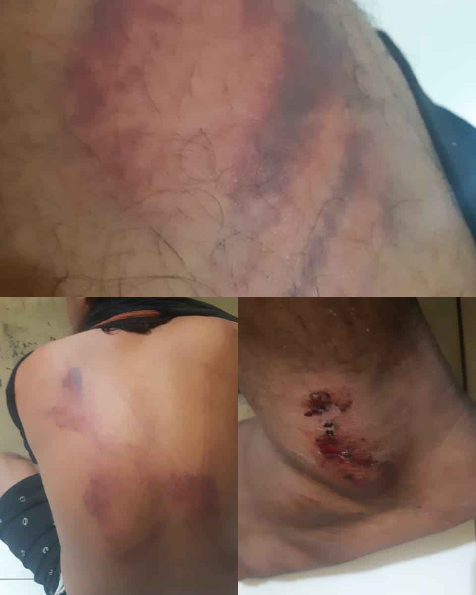 luka pada punggung korban penganiayaan yang diduga dilakukan oknum anggota polres pasuruan kota