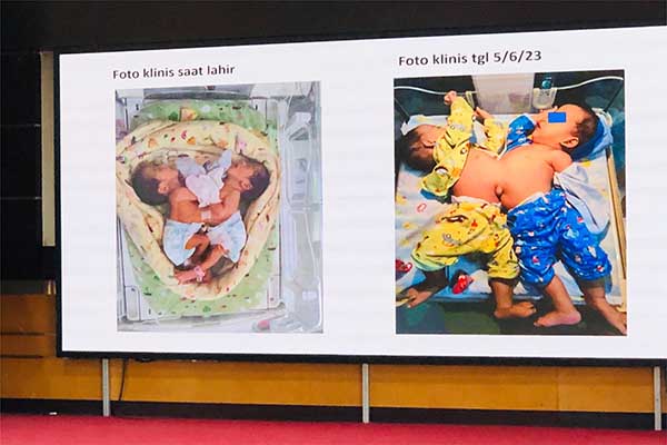 Kondisi bayi kembar siam yang akan dioperasi di RSSA. (wul) - RSSA Bakal Operasi Pemisahan Bayi Kembar Siam Pertama
