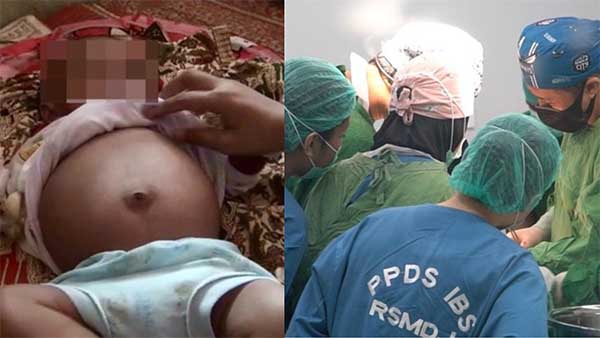 Operasi bayi 5 bulan yang mengalami teratoma. (ist) - Bayi 5 Bulan Hamil Sudah Dioperasi, Begini Hasilnya