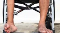 Salah satu akibat terserang virus Polio. (ist) - Dinkes Batu Ajak Warga Sukseskan Sub PIN Polio, Cegah Kasus Lumpuh Layu