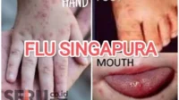 700 Dewasa Hingga Anak-anak Indonesia Terpapar Flu Singapura, Kenali Cirinya!