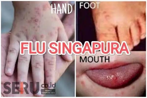 700 Dewasa Hingga Anak-anak Indonesia Terpapar Flu Singapura, Kenali Cirinya!