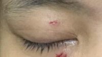 Unggahan Instagram korban menunjukkan tanda luka bekas penganiayaan. (ist) - Viral! Wanita Diduga Dianiaya Oknum Polisi Gara-gara Notifikasi DM Instagram