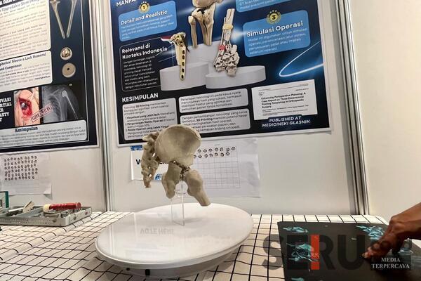 Inovasi 3D Printing. ska Inovasi 3D Printing FK UB Optimalikan Akurasi Operasi Patah Tulang