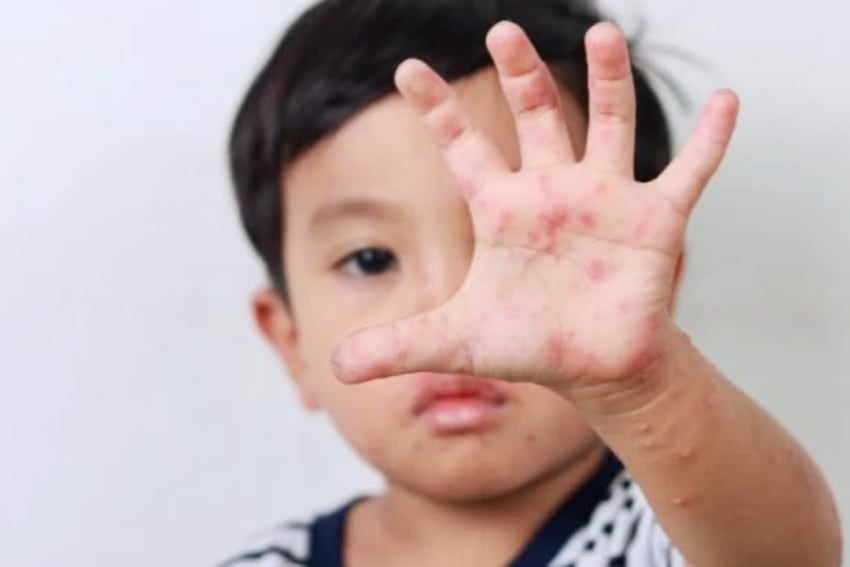 Kasus Campak di Kota Malang Menurun, Warga Diimbau Perhatikan Imunisasi dan PHBS Kasus Campak di Kota Malang Menurun, Warga Diimbau Perhatikan Imunisasi dan PHBS